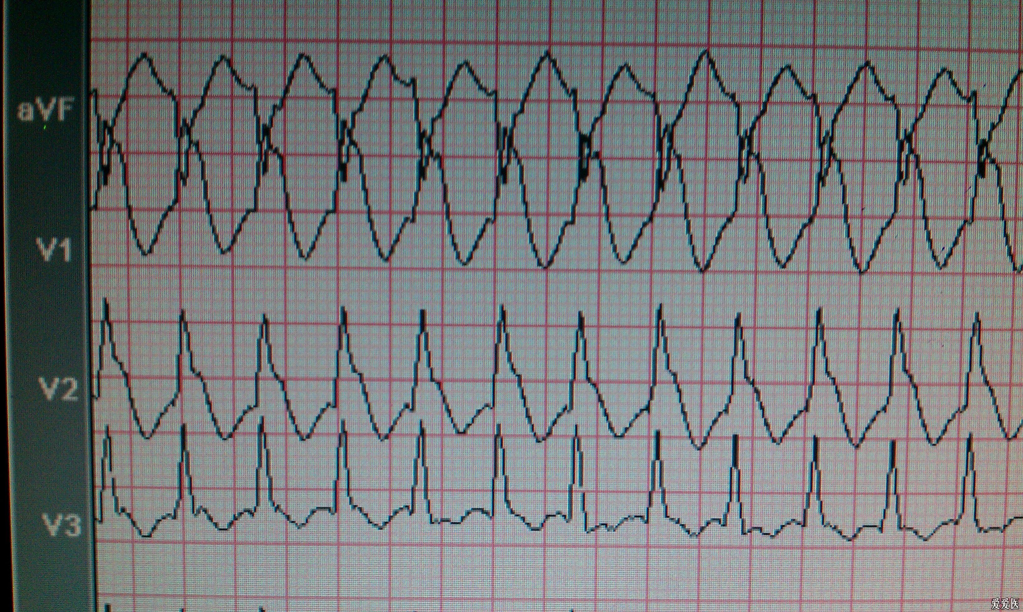 室速or室上速伴室差?(附复查ecg) - 心电图脑电图专业