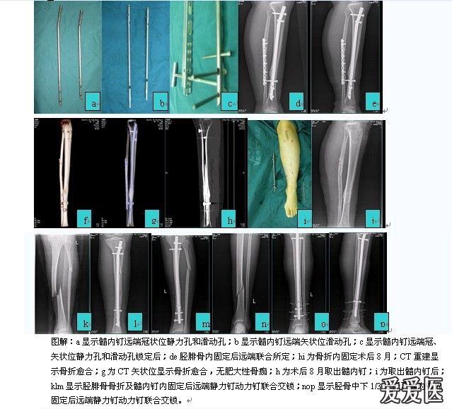 小腿中下段螺旋形骨折髓内针固定锁钉安装后发现有旋转移位