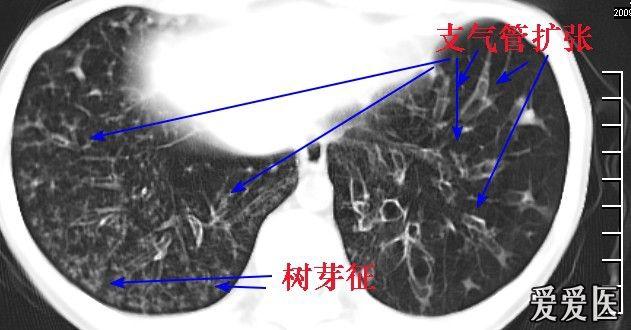 经典胸片展示之三--支气管扩张