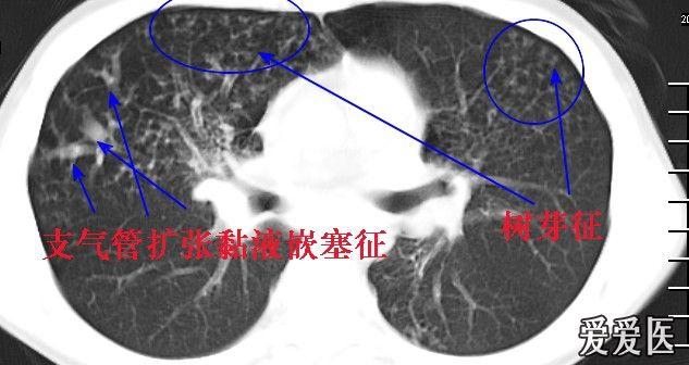 经典胸片展示之三--支气管扩张