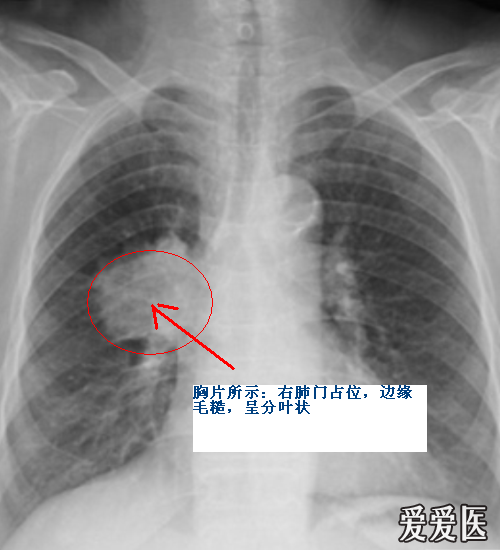 一)中央型肺癌 多为一侧肺门类圆性阴影,边缘大多毛糙,有时有分叶表现