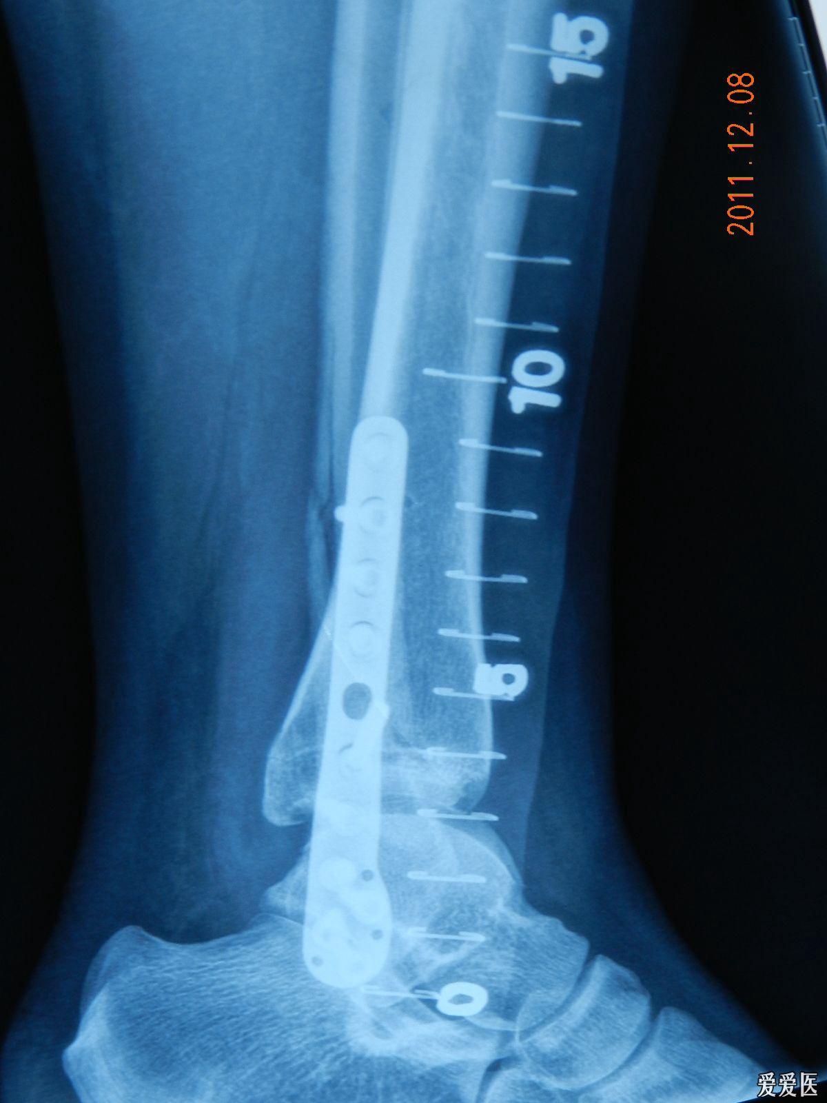69 经皮下胫腓联合内固定螺钉取出术 踝部骨折多伴有下胫腓联合分离
