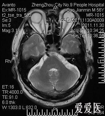 左环池内高密度灶蛛网膜下腔出血软脑膜撕裂