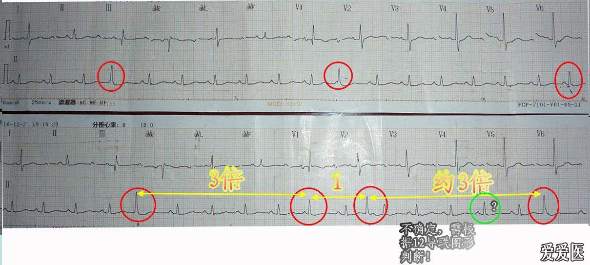心电图学习20111203有奖读图第四期公布结果