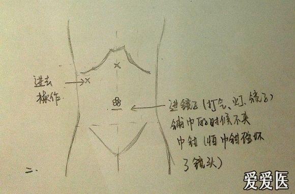 【简易说明】腹腔镜胆囊切除术