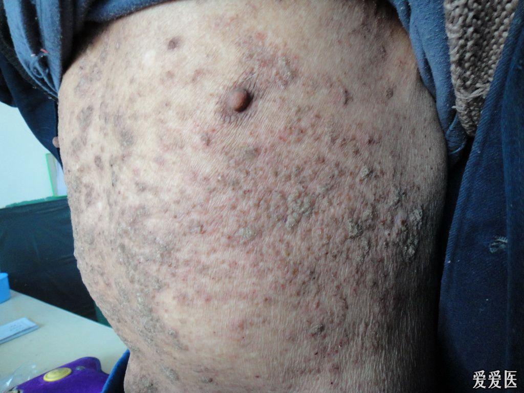 看图诊断59……皮肤淀粉样变(图片已经更新,37楼)