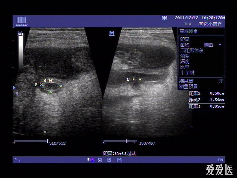 阑尾穿孔伴周围脓肿 - 超声医学讨论版 - 爱爱医医学