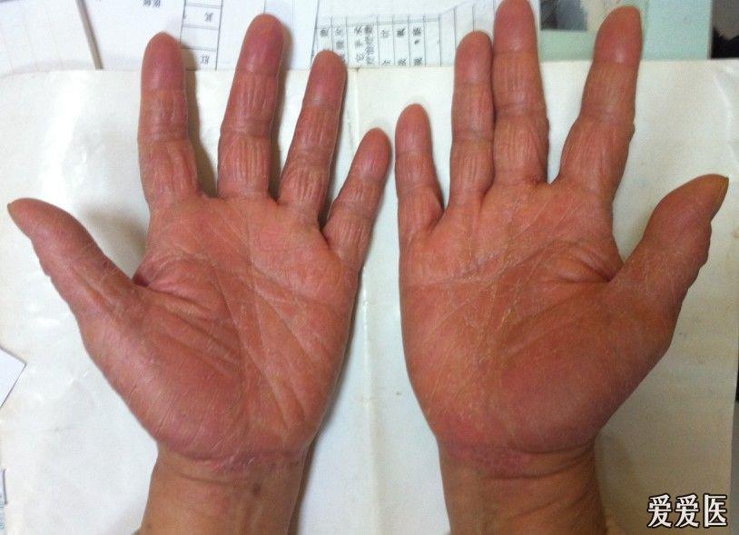 双手红斑角化过度皲裂皮疹病例讨论诊断指掌角化症已更新