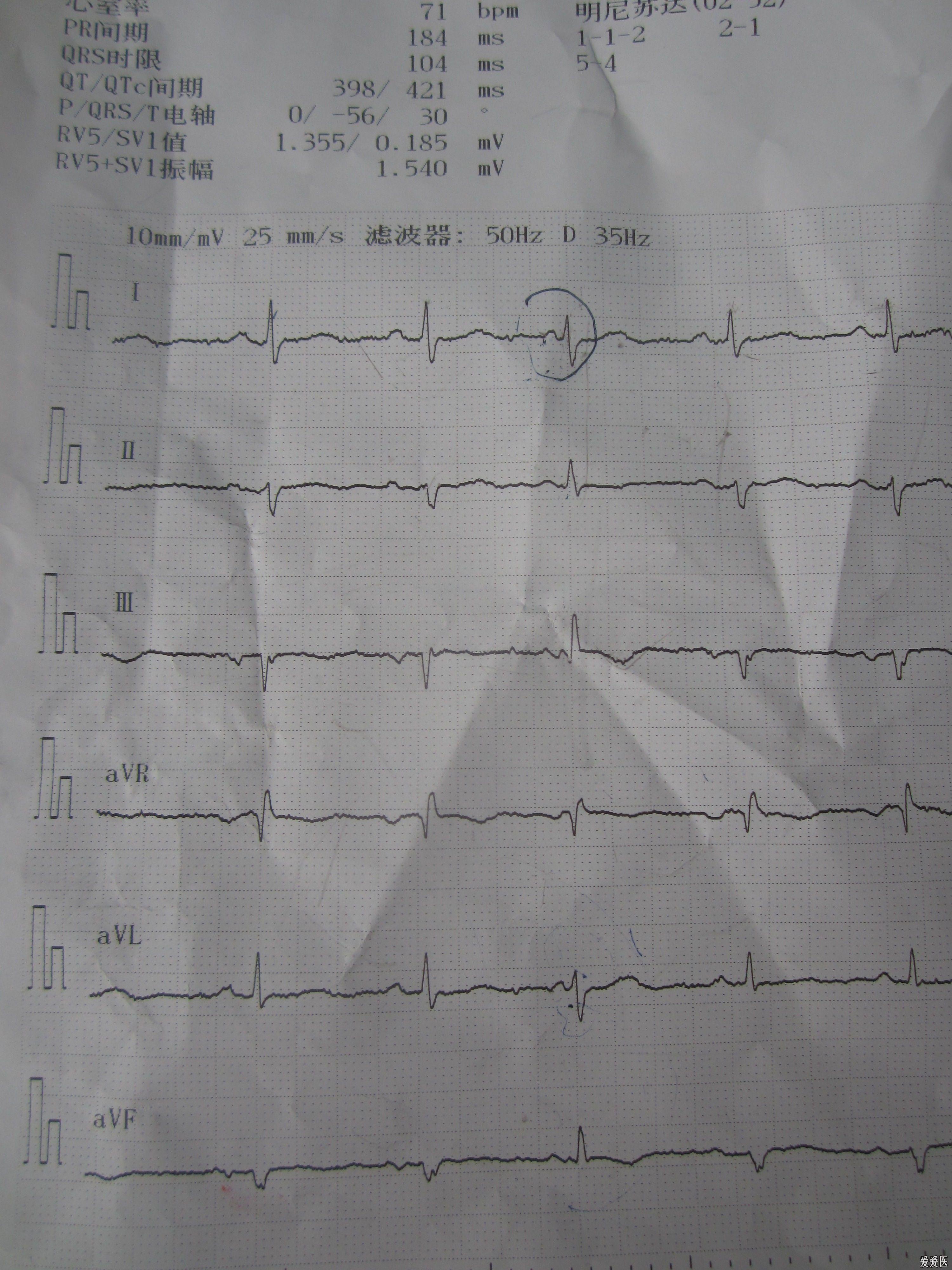 请高手分析心电图