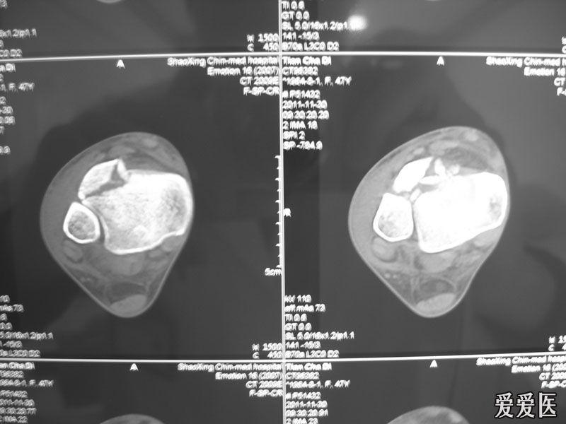 成人tillaux?chaput骨折1例