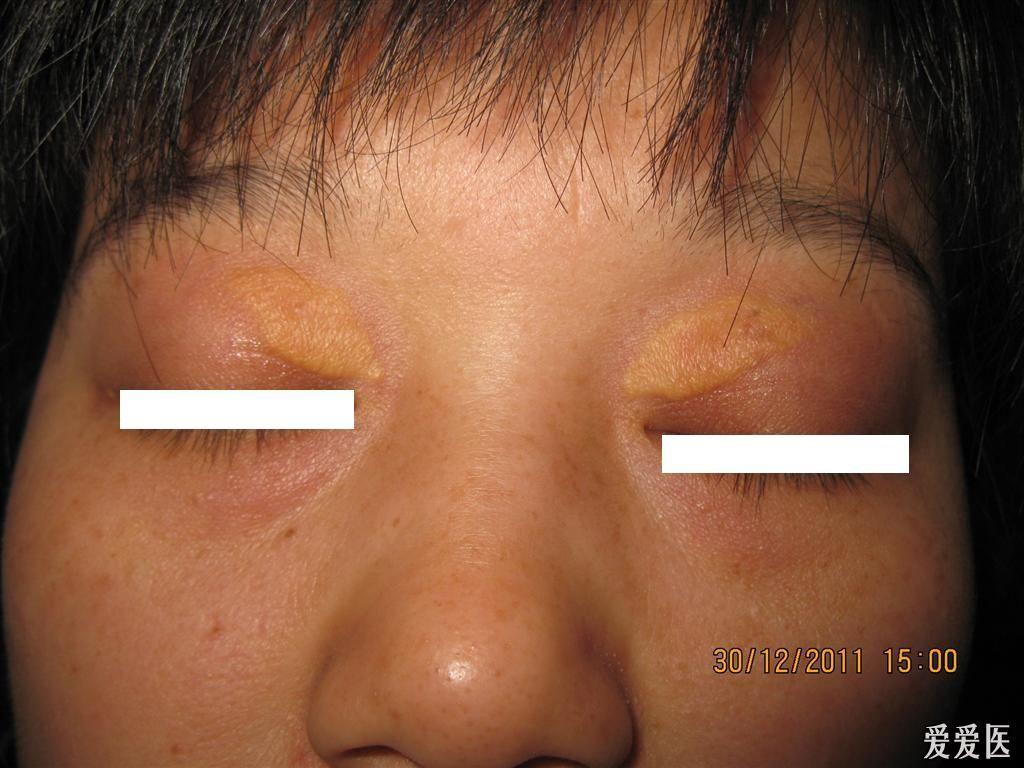 典型病例--------典型的睑黄瘤