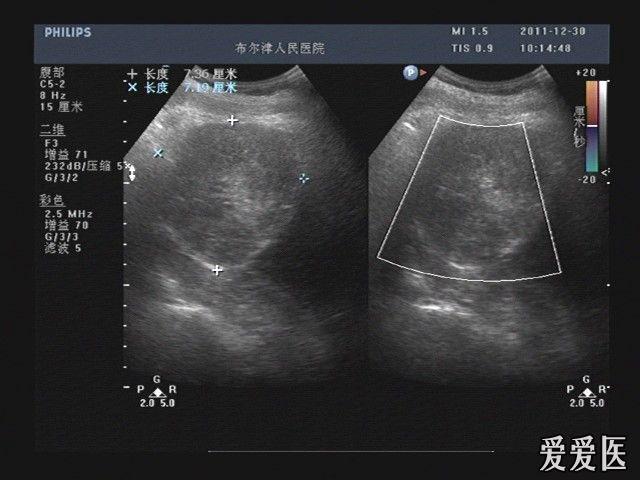 肝包虫大全 - 超声医学讨论版 - 爱爱医医学论坛