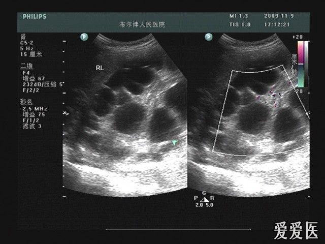 肝包虫大全 - 超声医学讨论版 - 爱爱医医学论坛