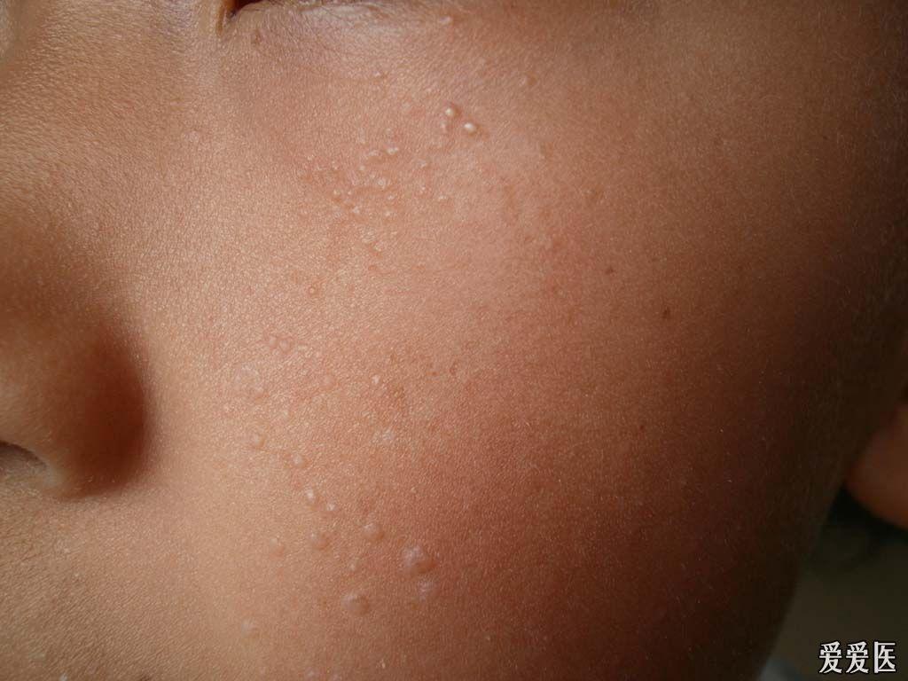 小儿面部同患两种皮肤病-扁平疣,粟丘疹.