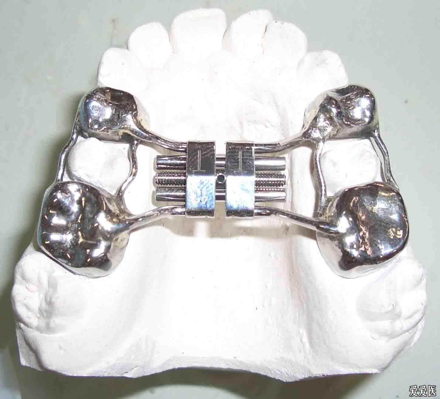 各种活动矫治器 口腔医学专业讨论版 爱爱医医学论坛