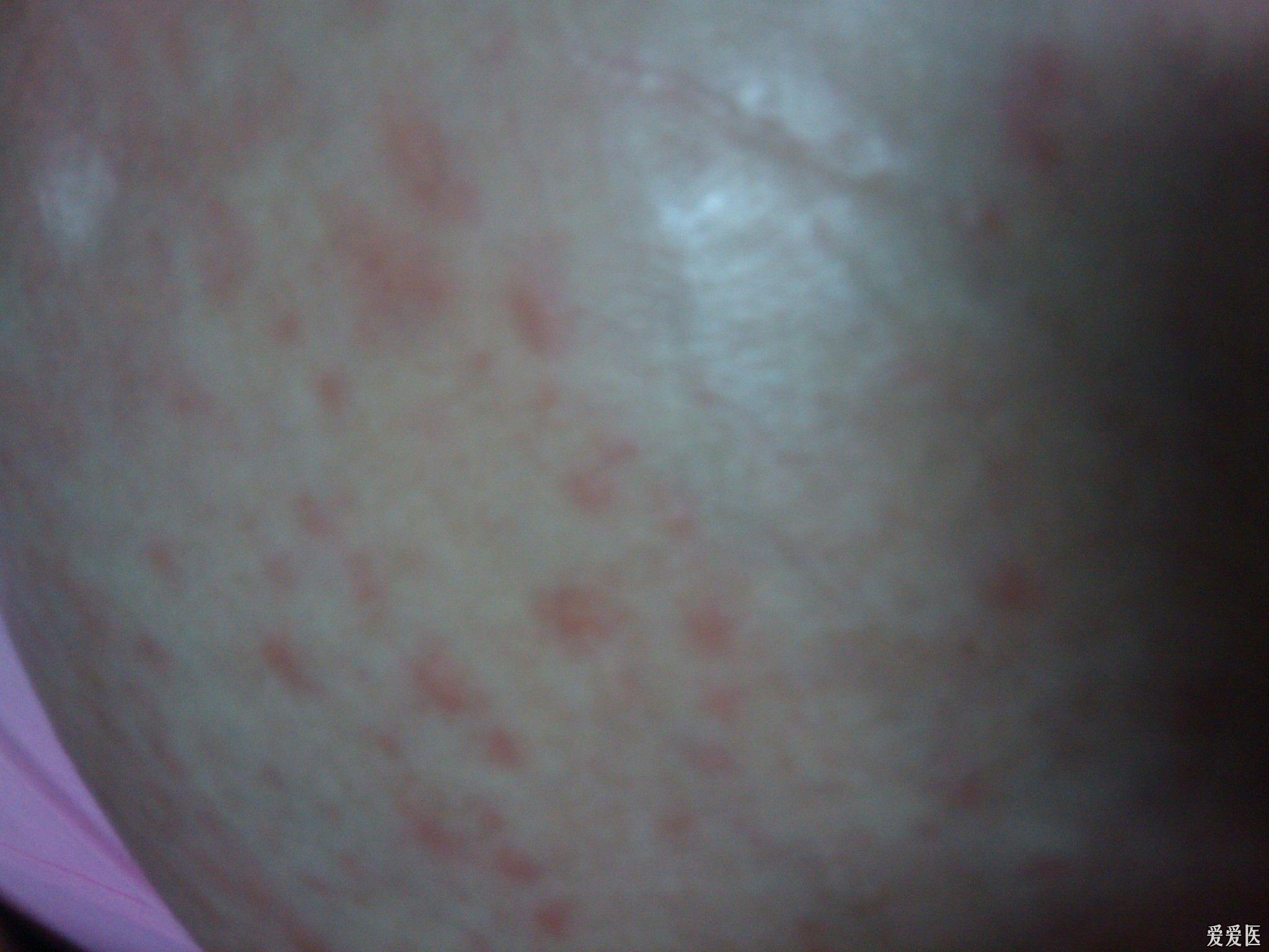 一个孕39周的孕妇,肚皮起的红色皮疹,奇痒 ,附有图片
