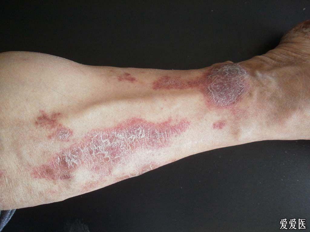 典型病例--淤积性皮炎.