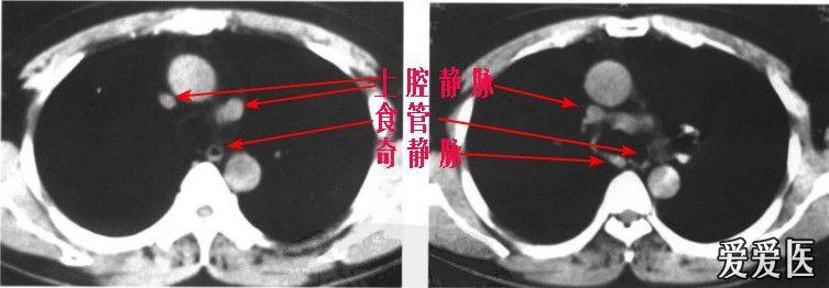 第37期(结果见18楼)   ct扫描示升主动脉右后方见上腔静脉,其左后见