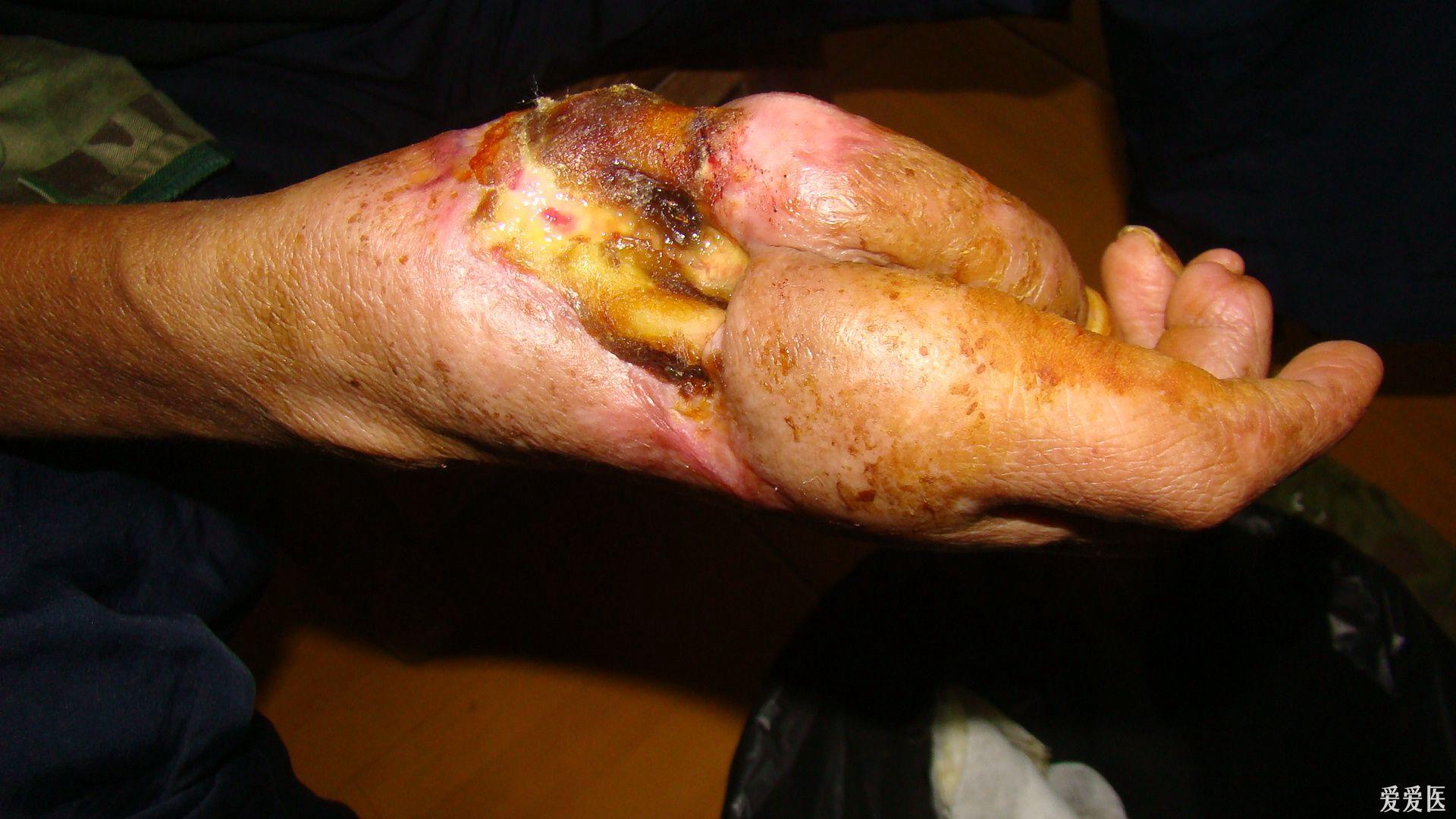 五步蛇咬伤右手背侧3个月后掌骨外露如何处理