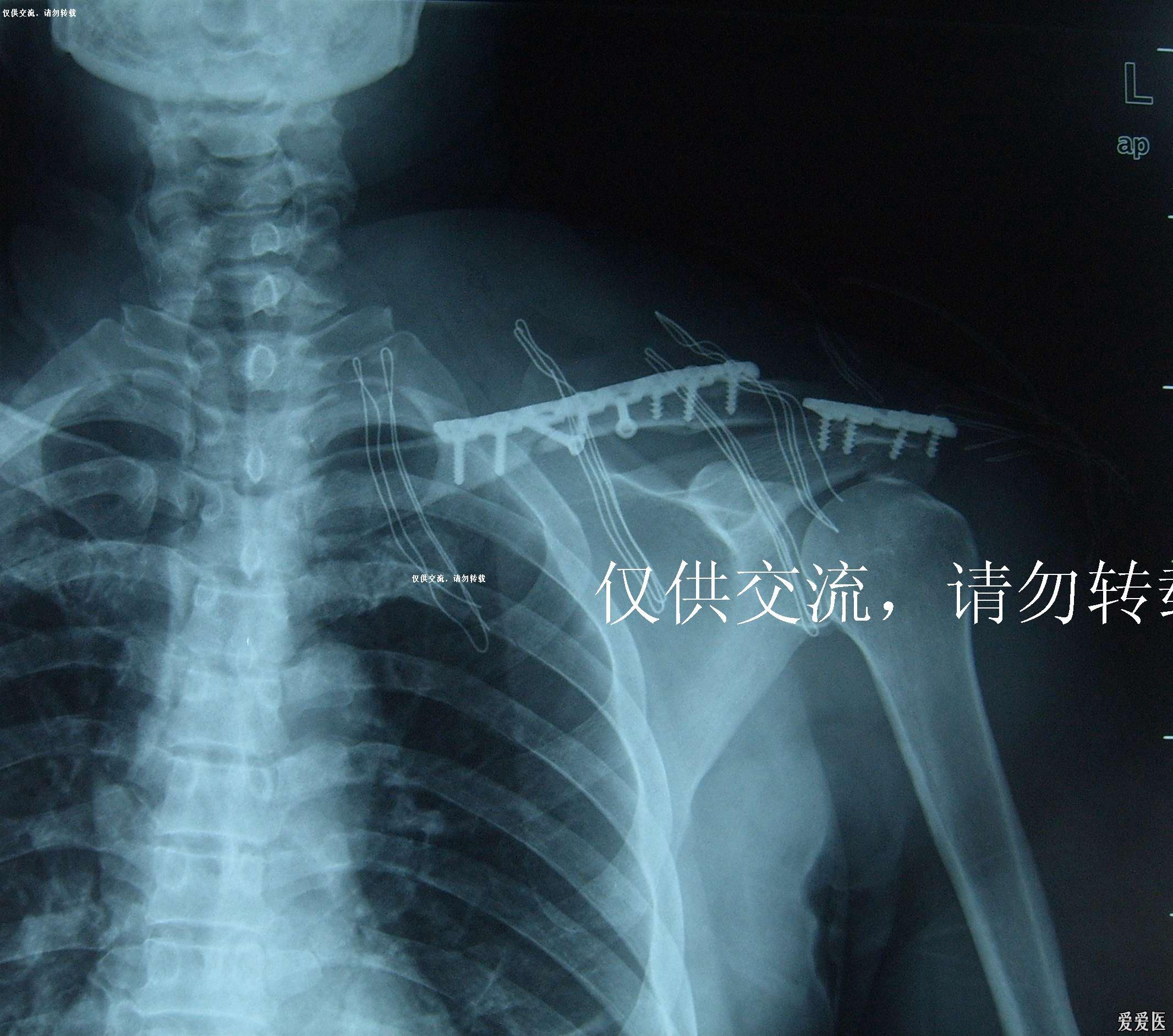 一例锁骨骨折合并肩峰骨折的治疗