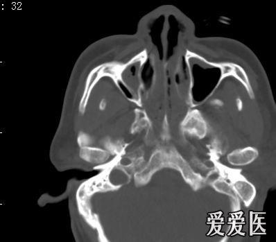 考虑左侧蝶骨大翼骨纤