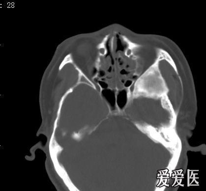 考虑左侧蝶骨大翼骨纤