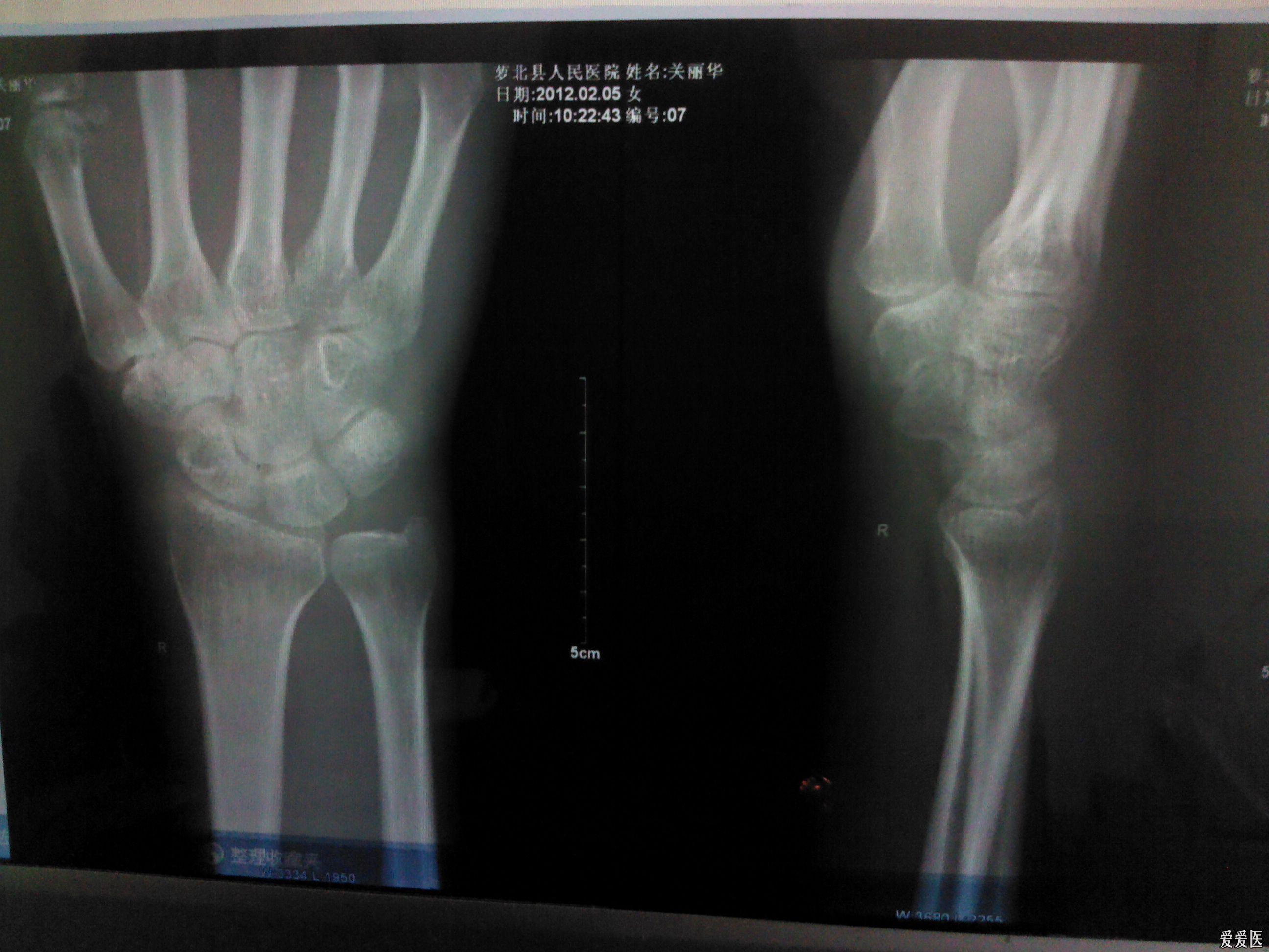求助诊断患者女腕关节肿痛3个月有余附x光片