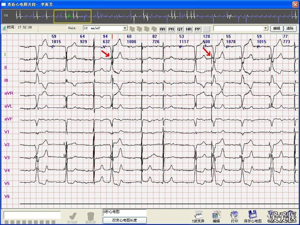 请高手帮忙看看这份起搏器心电图