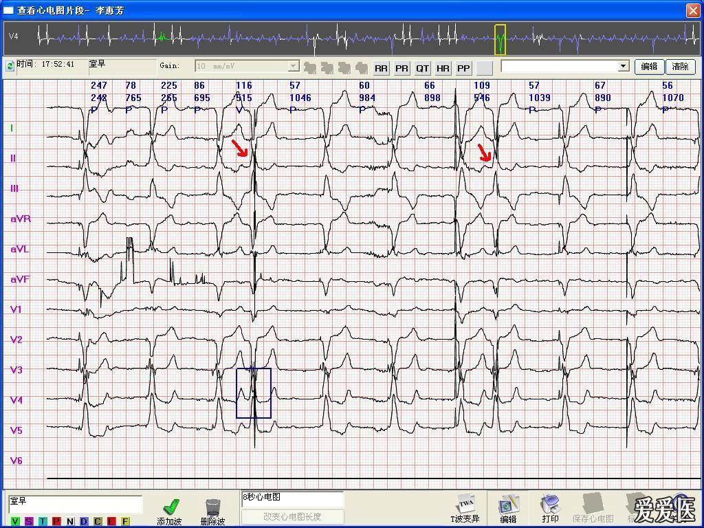 请高手帮忙看看这份起搏器心电图