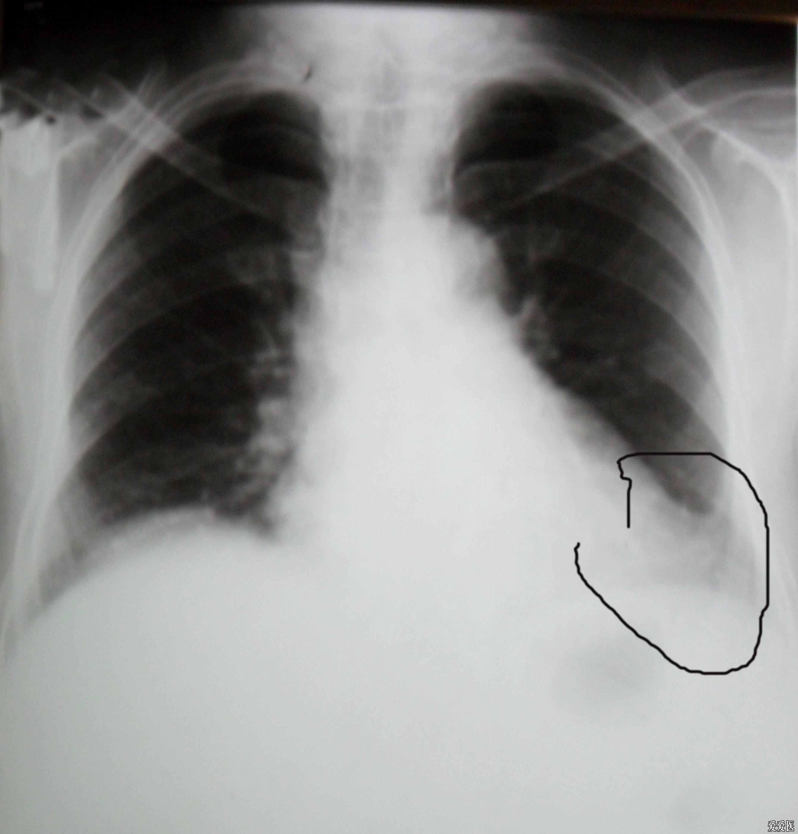 胸片 医学影像学讨论版 爱爱医医学论坛
