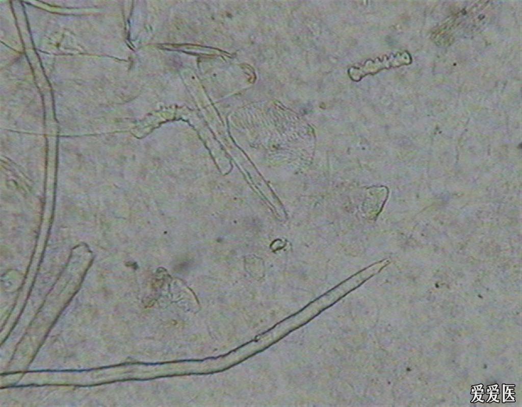 帮忙看看是什么病(镜下小虫一样的是什么东西)