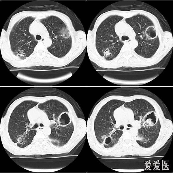 肺曲霉菌病ct片