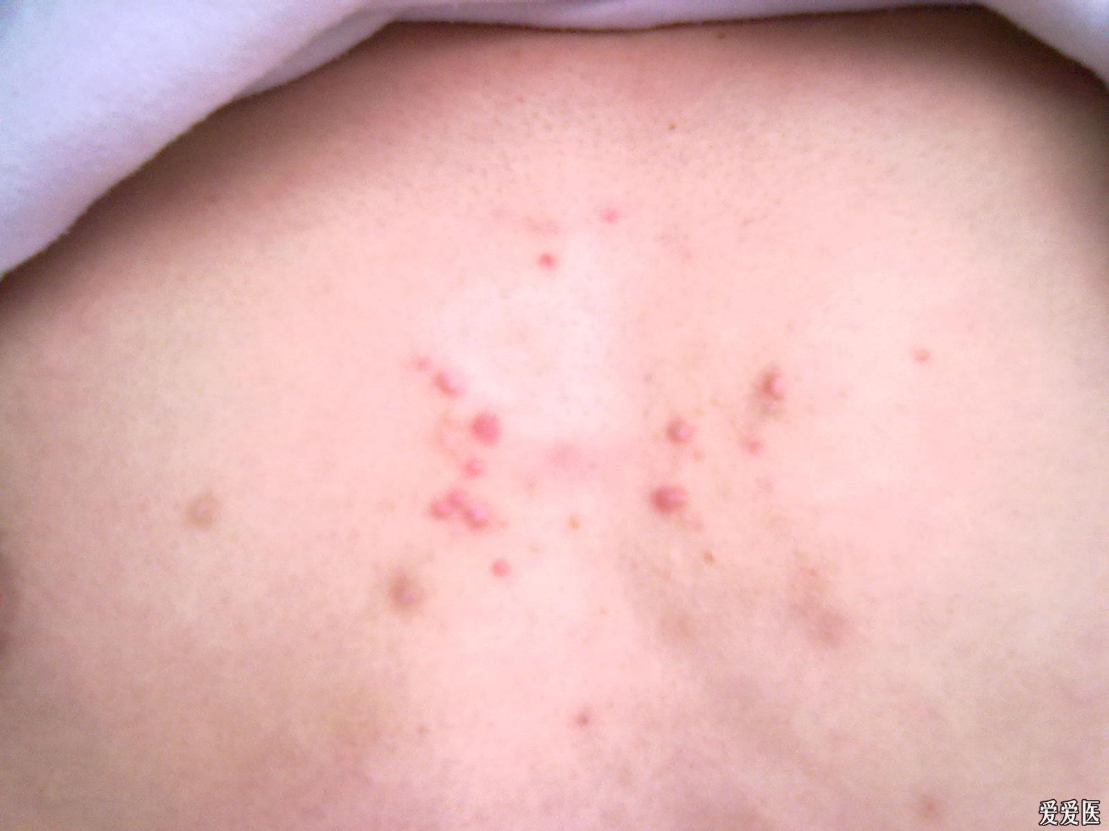 年轻男性,胸前红色小丘疹三个月,无明显瘙痒,请问大家是什么病啊