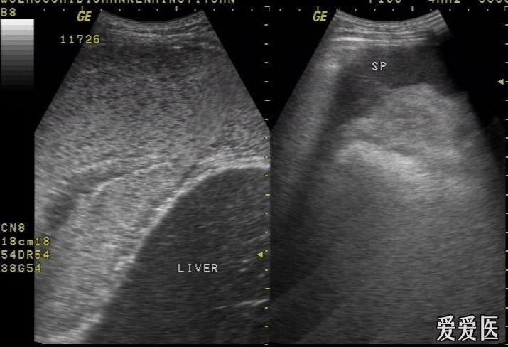 胸腔积液(脓胸) - 超声医学讨论版 - 爱爱医医学论坛