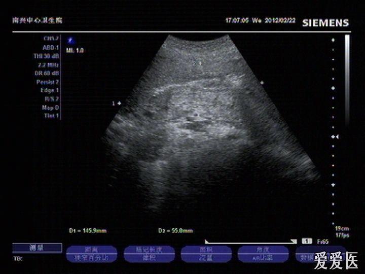 子宫底与腹壁粘连