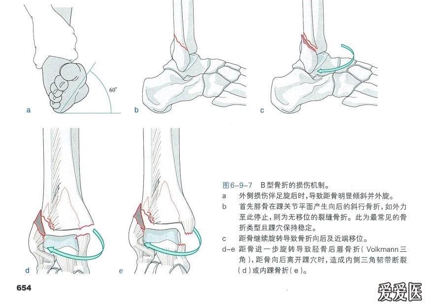 讨论踝关节的分型和治疗,要不要固定下胫腓关节.