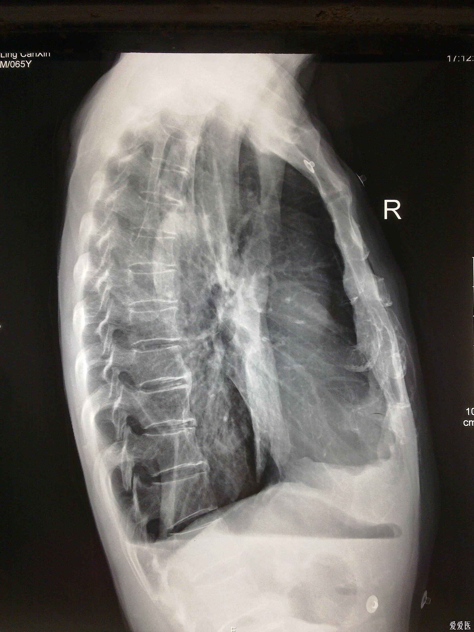 典型的结核病人液气胸胸片