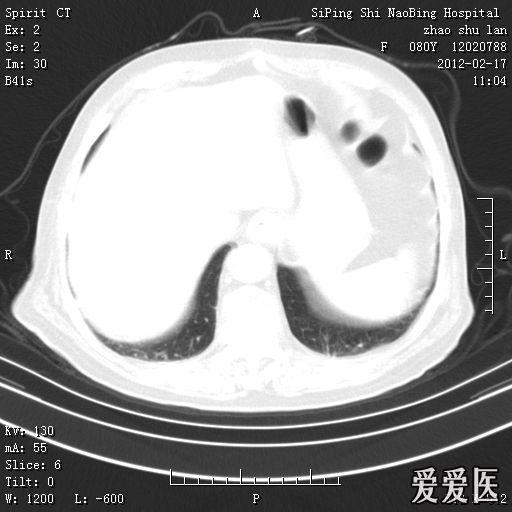 女性患者80岁头晕头痛头部核磁平扫增强肺部ct