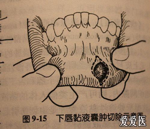 今天下午做的一例粘液腺囊肿手术照片