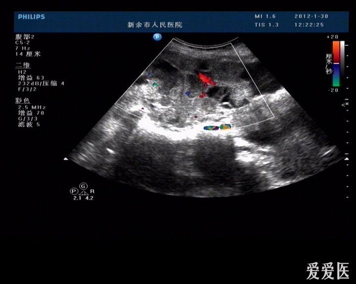 69 超声医学讨论版 69 典型病例-转移性肝ca,腹水,库肯勃氏瘤