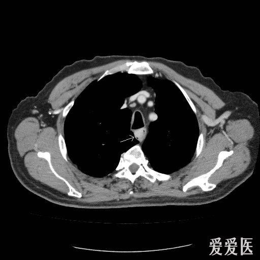 食管癌术前评估 医学影像学讨论版 爱爱医医学论坛