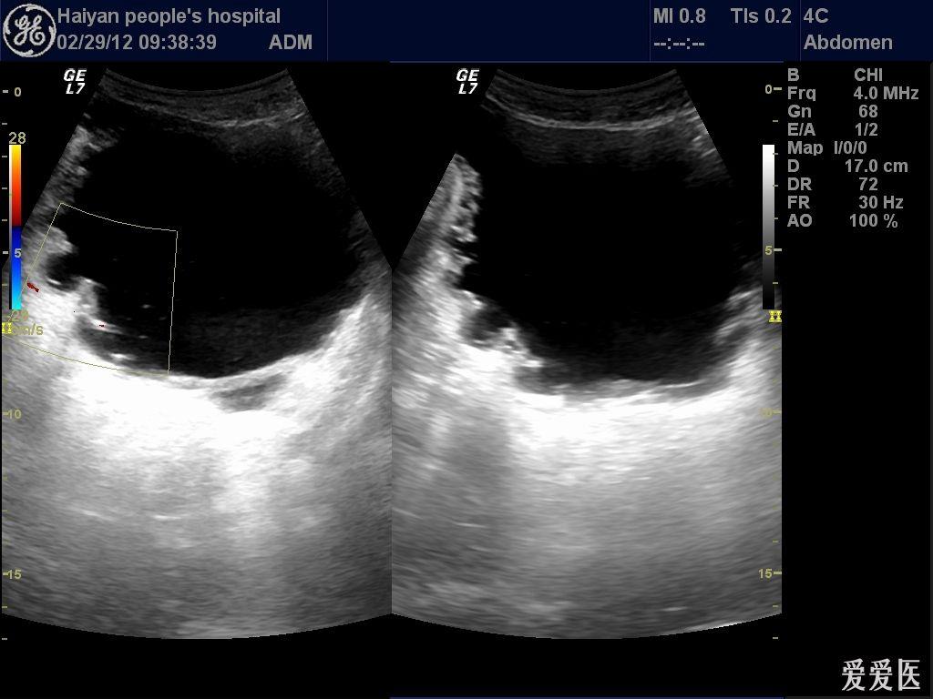 膀胱图片 第2页 超声医学讨论版 爱爱医医学论坛