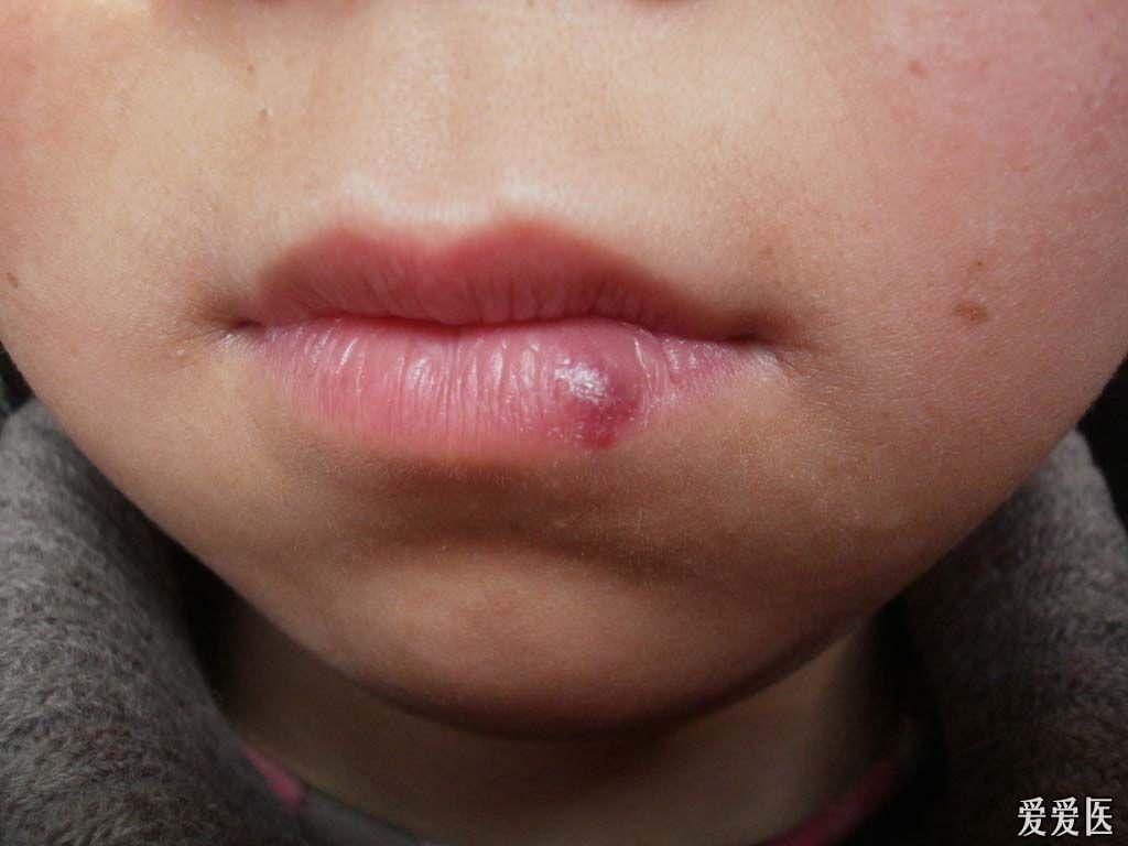 口唇の血管腫 －静脈湖－ - SSクリニック - 皮膚科・美容外科 - 名古屋市中区