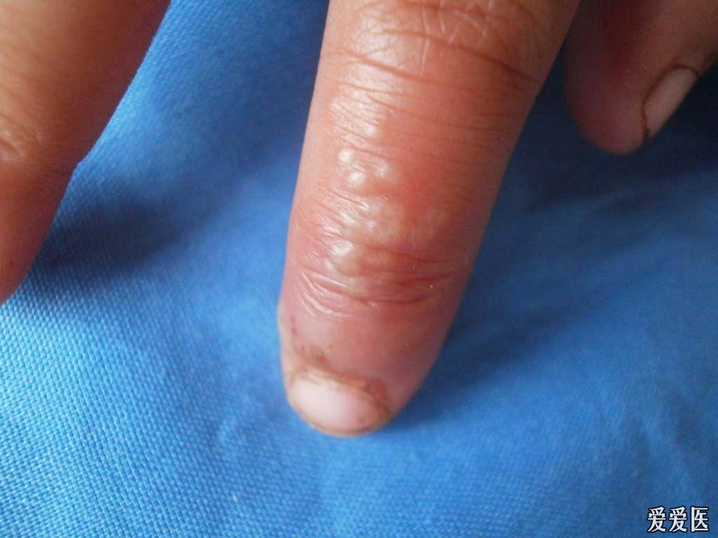典型病例:手指单纯疱疹.