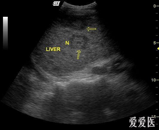 肺ca,肝转移,间隙腔内,菊花后腹膜淋巴结转移小心你的腹膜图片
