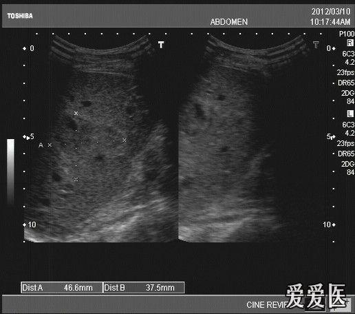 奇怪的"肝挫裂伤?" - 超声医学讨论版 - 爱爱医医学