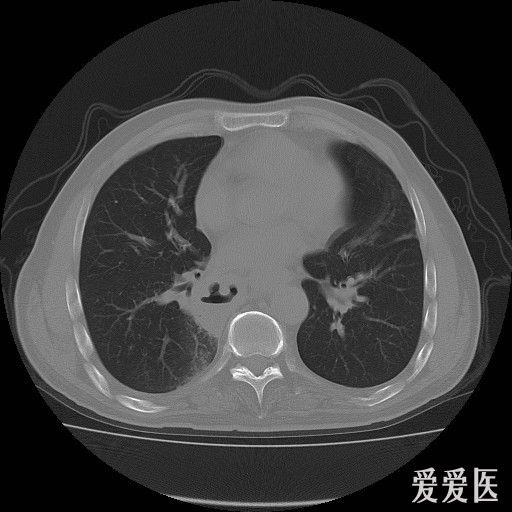 读片——胸部ct