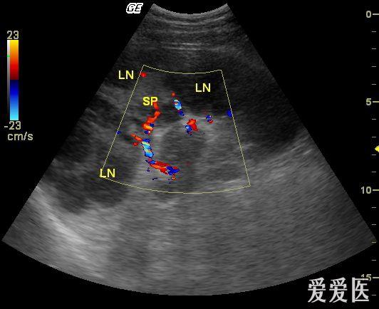 脾脏恶性淋巴瘤 超声医学讨论版 爱爱医医学论坛