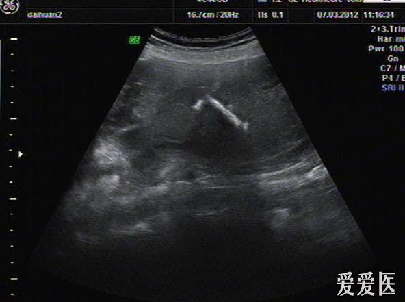 t形环和胎儿一起展现,圆形环在羊水中常见,t形的大家猜尾丝去哪了?