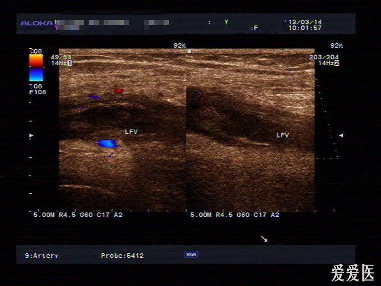 左股静脉血栓形成 - 超声医学讨论版 - 爱爱医医学论坛